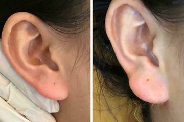 Setelah Trend Potong Telinga untuk Awet Muda, Kini Filler Telinga Mirip Buddha untuk Keberuntungan