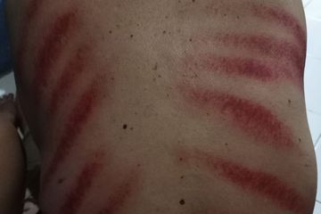 Jangan Coba-coba Kerokan di 5 Bagian Tubuh Ini, Efeknya Bisa ...