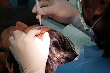 Berharap Bisa Tampil Sempurna, Pria di India Meninggal Dunia Setelah Menjalankan Transplantasi Rambut, Inilah Risiko yang Terjadi