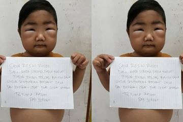 Seorang anak dengan sindrom nefrotik.