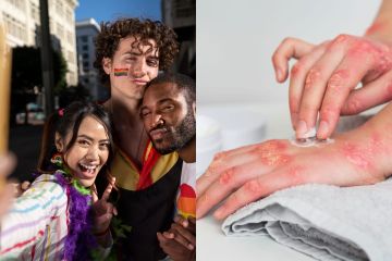 Cacar monyet banyak diderita LGBT. WHO; Rata-rata dialami pria homo alias gay.