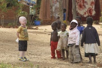 Cassim Jaffalie, 3, yang menderita albinisme, berdiri bersama teman-temannya  di sebuah kota di Malawi. Sering menghadapi diskriminasi.
