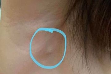 Benjolan di ketiak ada yang berbahaya dan ada yang tidak.