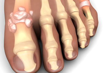 Pembentukan kristal pada kaki jempol sudah menjadi gejala umum dari asam urat, namun kenalilah gejala lainnya untuk tahu kapan harus menemui dokter.