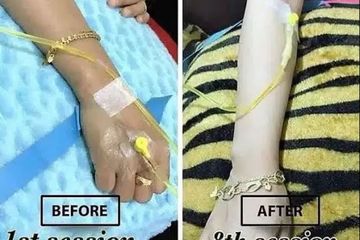 Akhirnya Menyesal, Rutin Infus Whitening Wanita Muda Ini Jadi Pasien Autoimune