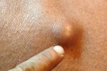 Benjolan lemak alias lipoma.