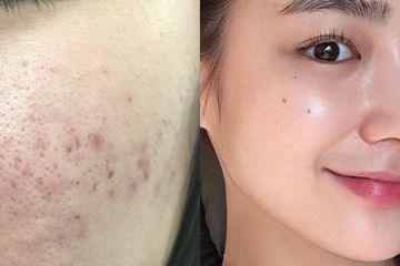 Kulit wajah bopeng bisa diatasi dengan berbagai cara.
