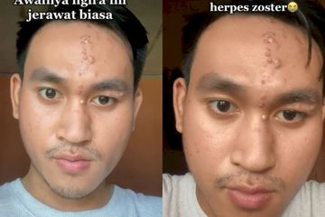 Mengidap Penyakit Infeksi Herpes Zoster di Wajah, Apakah Berbahaya?