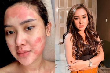 Berharap Jadi Tambah Cantik, Cita Citata Justru Divonis Idap Penyakit Autoimun Setelah Melakukan Suntik Putih, Ternyata Beginilah Efek Jangka Panjang yang Perlu Diwaspadai