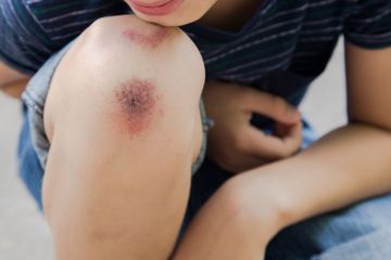 Cara menghilangkan bekas luka menghitam dengan mudah 