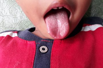 Mengatasi Lidah Putih karena Demam, Sebelum Berobat ke Dokter Bisa ...