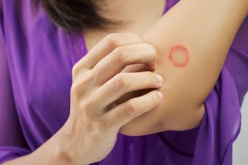 Ringworm Bisa Menular dari Hewan Peliharaan, Ini 8 Cara Mencegahnya