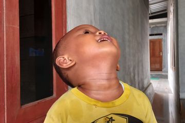 Cara Menghilangkan Daki di Leher Anak, Cepat dan Alami juga Murah