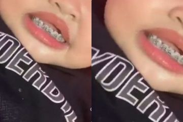Pemakaian behel saat balita berisiko mengganggu pertumbuhan gigi anak.