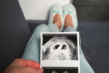 Risiko Hamil Kembar Identik, Twin to Twin Transfusion Syndrome 