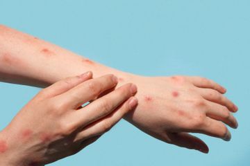 Menular Melalui Kontak Erat, Ini 5 Gejala Cacar Monyet yang Banyak Terjadi