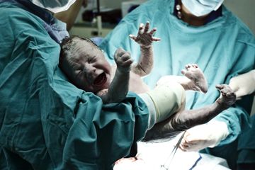 Bayi Lahir Sesar Perlu Fisioterapi, Ada Proses yang Terputus Saat Lahir ke Dunia