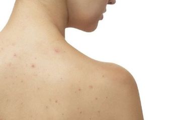 Penyebab Jerawat Muncul di Badan dan Cara Cepat Mengobatinya