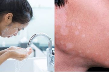 Cuci Muka Saat Berkeringat Sebabkan Panu di Wajah, Mitos atau Fakta?