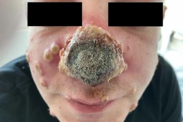 Hati-hati, Penderita HIV yang Terkena Cacar Monyet Bila Tak Diobati Bisa Mengalami Infeksi Parah, Pria di Jerman Hidungnya Sampai Membusuk