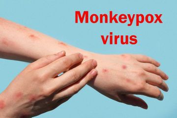 Kini tidak ada lagi Monkeypox atau cacara monyet.