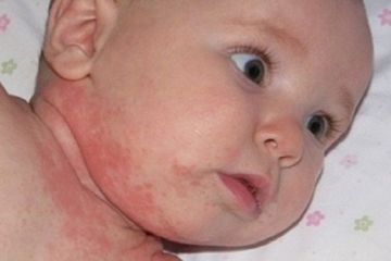 Obat Apotek dan Alami Rekomendasi untuk Mengatasi Ruam pada Bayi