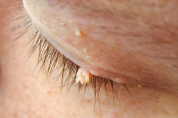 Kutil kulit di sekitar mulut yang sering diabaikan