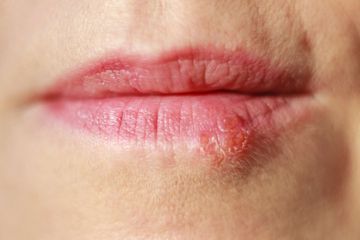 Inilah bentuk bibir yang menjadi ciri khas seseorang terkena herpes di mulut, beda dengan sariawan.