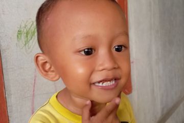 Faktor penyebab terjadinya gigi hitam pada anak