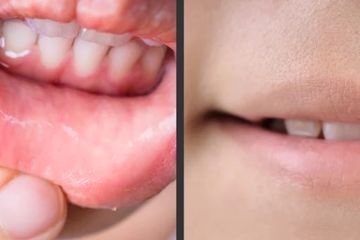 Perlu Tahu, Memiliki Gejala Sama, Ada Perbedaan Herpes di Mulut dan Sariawan yang Tidak Boleh Disepelekan Keberadaanya!