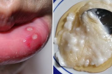 Meski bisa sembuh sendiri, cobalah gunakan empat bahan alami atasi sariawan ini, salah satunya dengan madu.