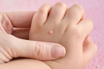 Begini cara mengatasi dan penyebab dari kutil pada anak, setidaknya ada lima jenis yang sering menyerang.