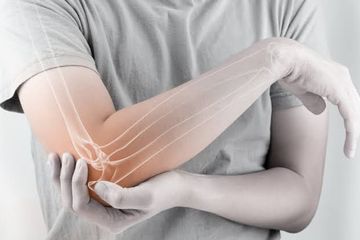 Jenis kanker tulang osteosarkoma, yang paling sering menyerang tulang di lengan.