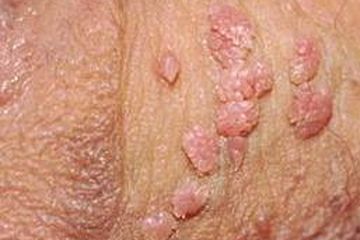 Coba Konsumsi Makanan Berikut, Ampuh Hilangkan Virus HPV Penyebab Kutil Kelamin
