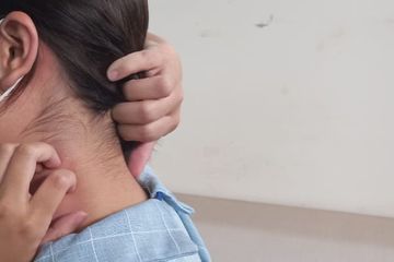 Tak perlu khawatir, inilah beberapa rekomendasi obat panu untuk anak yang dijual bebas di apotek