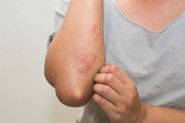 Macam Obat untuk Biduran di Apotek yang Aman dan Terjangkau