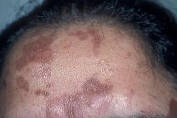 Bekas Luka Menghitam yang Membandel, Cukup Gunakan Obat Ini Langsung Hilang