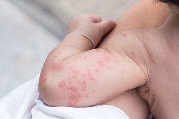 Bisa mengatasi ruam gatal yang parah dengan obat alami biduran pada bayi