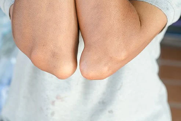 Asam urat, dapat diatasi dengan obat herbal.