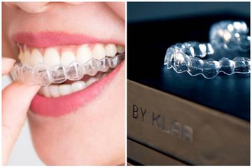 Klar Aligner dari Klar Smile, Solusi Gigi Jadi Rapi Berbasis Kedokteran Lebih Unggul dari Behel Gigi