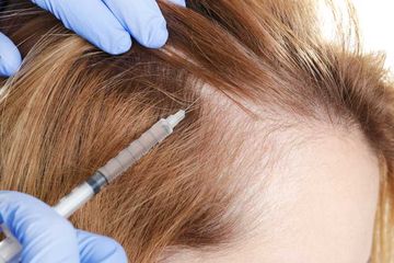 Berikut ini perawatan rambut rontok yang bisa dipilih, baik dengan disuntik atau pun dioles.