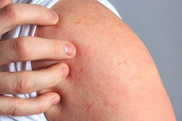 Biduran atau urtikaria, salah satu jenis alergi yang dapat diobati dengan obat antihistamin.