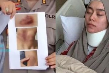 Menurut Dokter Bedah Melihat Kondisi Lesti Kejora, Kotak dan Pita Suaranya Kemungkinan Rusak Akibat Cekikan