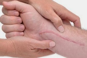 Cara ampuh menghilangkan bekas luka jahitan dengan bahan alami