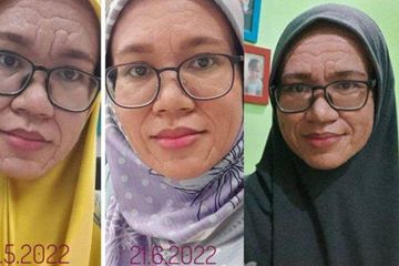 Tragis, Ibu Muda Setelah Melahikran Wajahnya Berubah Menjadi Seperti Nenek-nenek, Akibat Sebaceous Gland Hyperplasia (SGH)