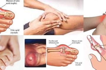 Inilah bagian-bagian tubuh yang terasa sakit akibat asam urat tinggi, perhatikan!