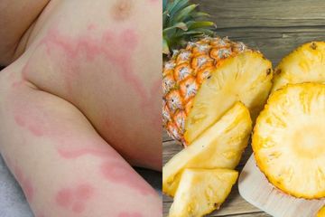 Nanas, menjadi salah satu makanan untuk penderita biduran yang mengandung antihistamin alami.