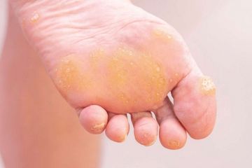 Jangan Anggap Remeh, Ini Dia Tips Mencegah Kaki dari Kapalan