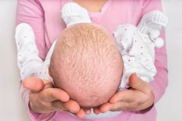 Psoriasis pada anak cenderung terjadi pada kulit kepala.