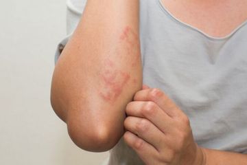 Merasa biduran tak kunjung sembuh, inilah beberapa cara yang dilakukan untuk mengurangi rasa gatal